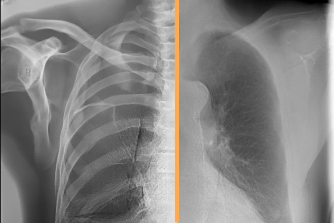 AI bone suppression and subtraction placeholder