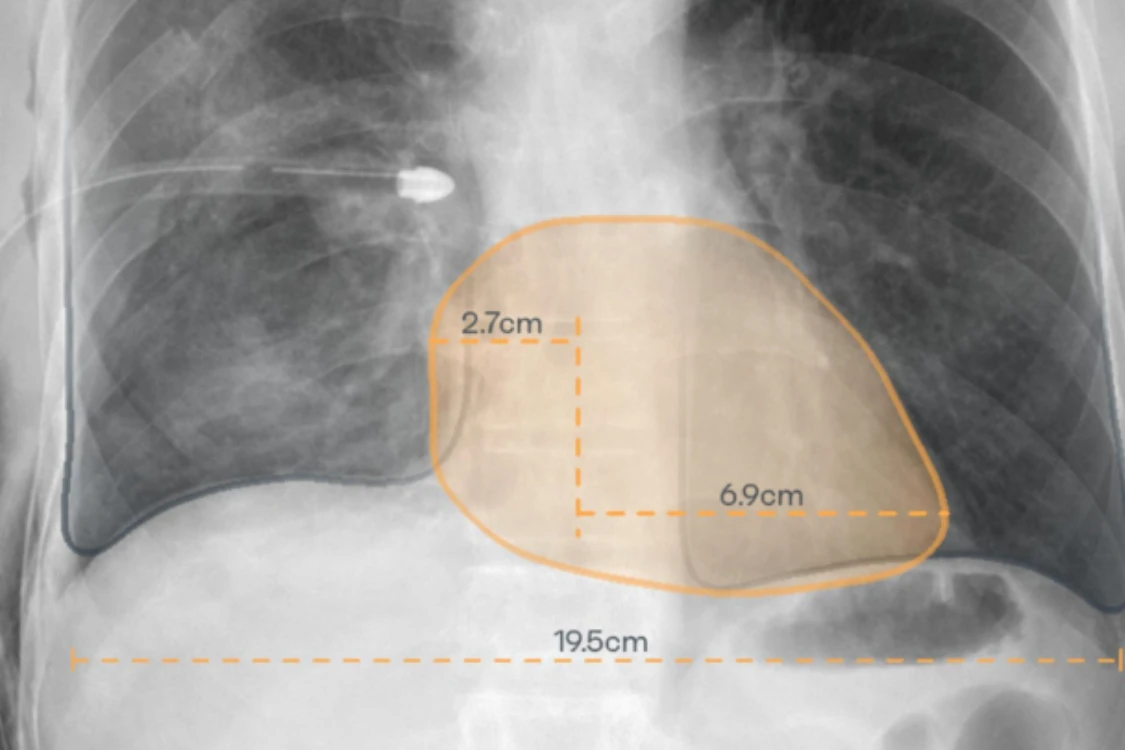 Cardio-thoracic index placeholder