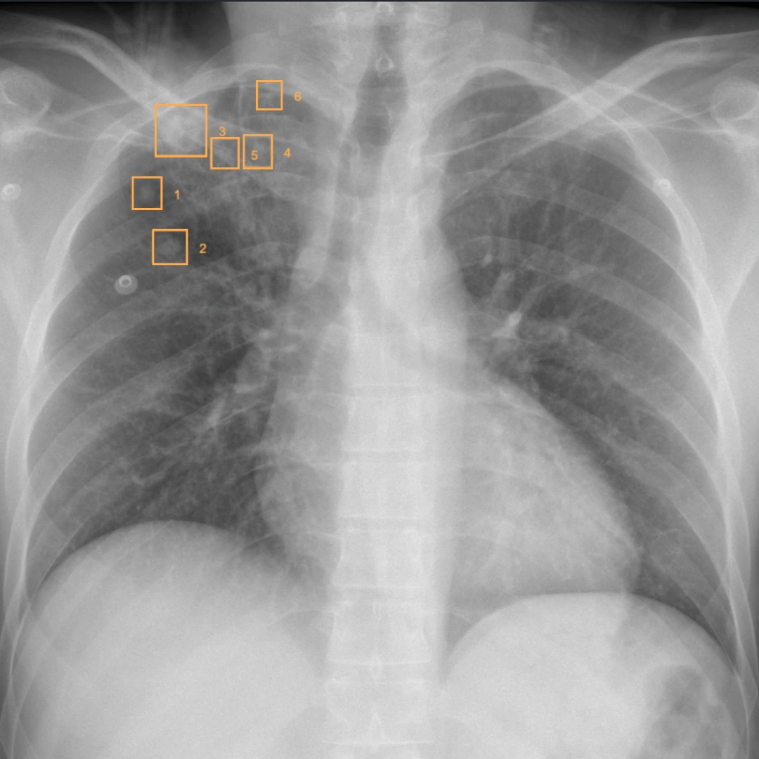Nodule masses detection preview